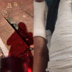 Mulher cai em bueiro no Bela Vista e sofre fraturas nas duas pernas em Santa Cruz do Rio Pardo